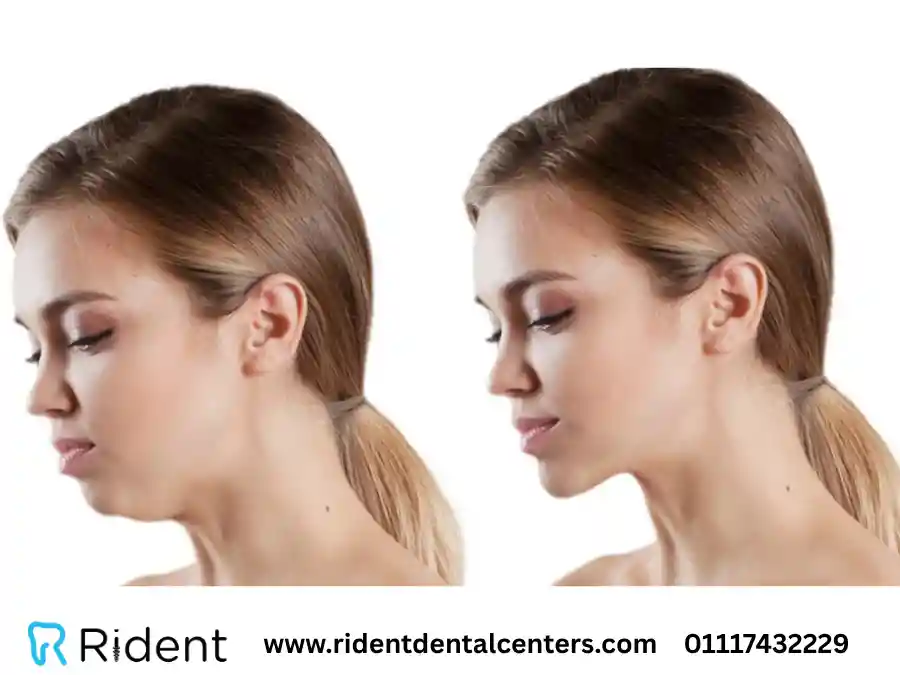 تقدم الاسنان العلوية